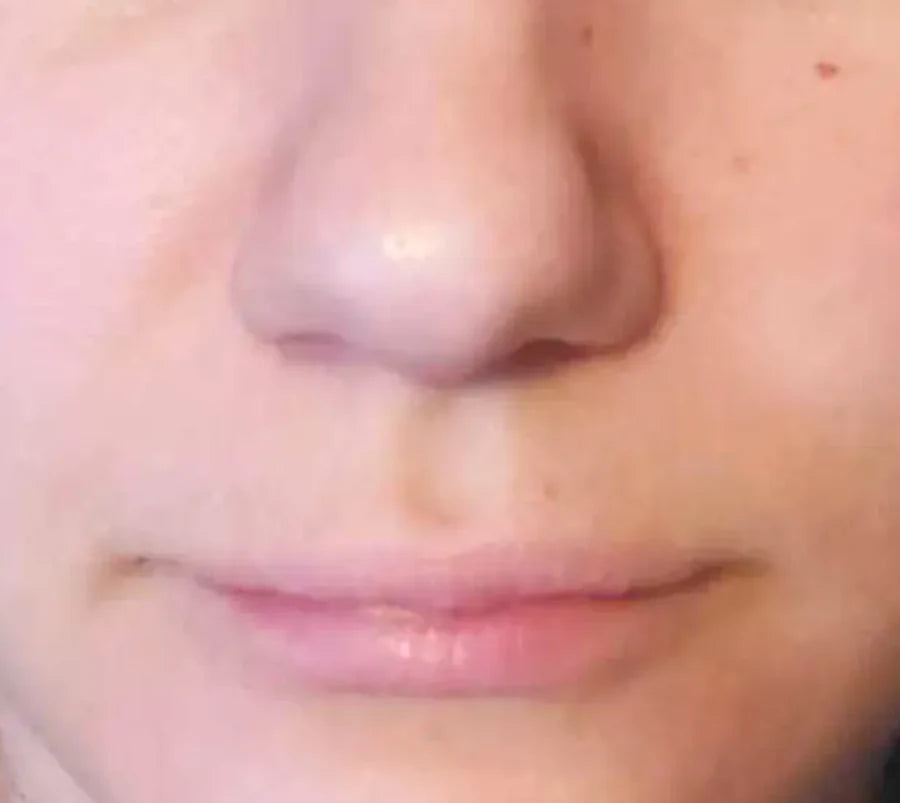 Skin after 30 days of Glow Shot