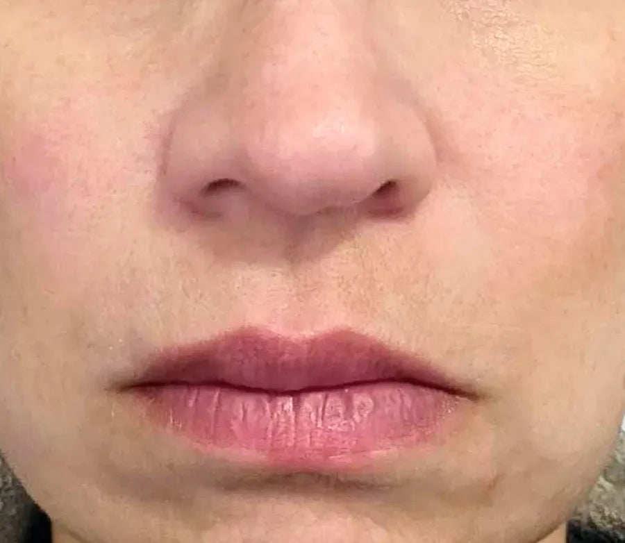Skin after 30 days of Glow Shot