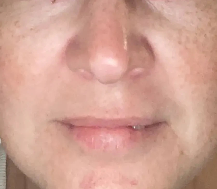 Skin after 30 days of Glow Shot