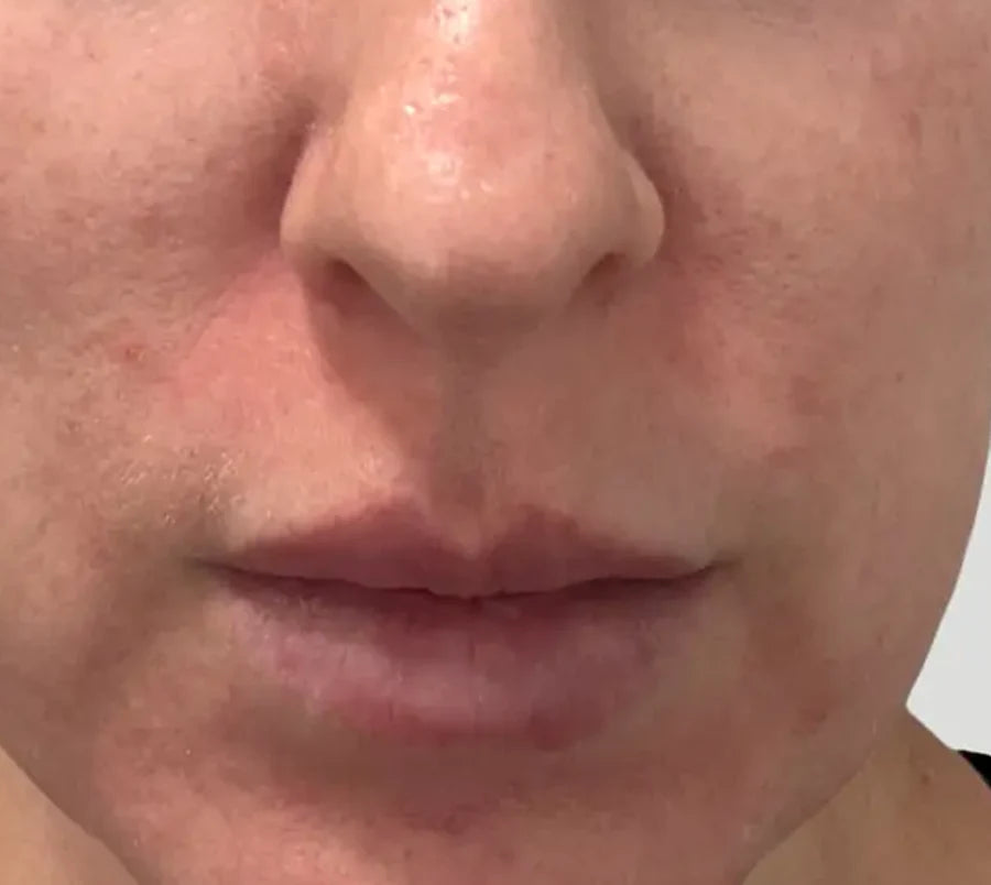 Skin after 30 days of Glow Shot