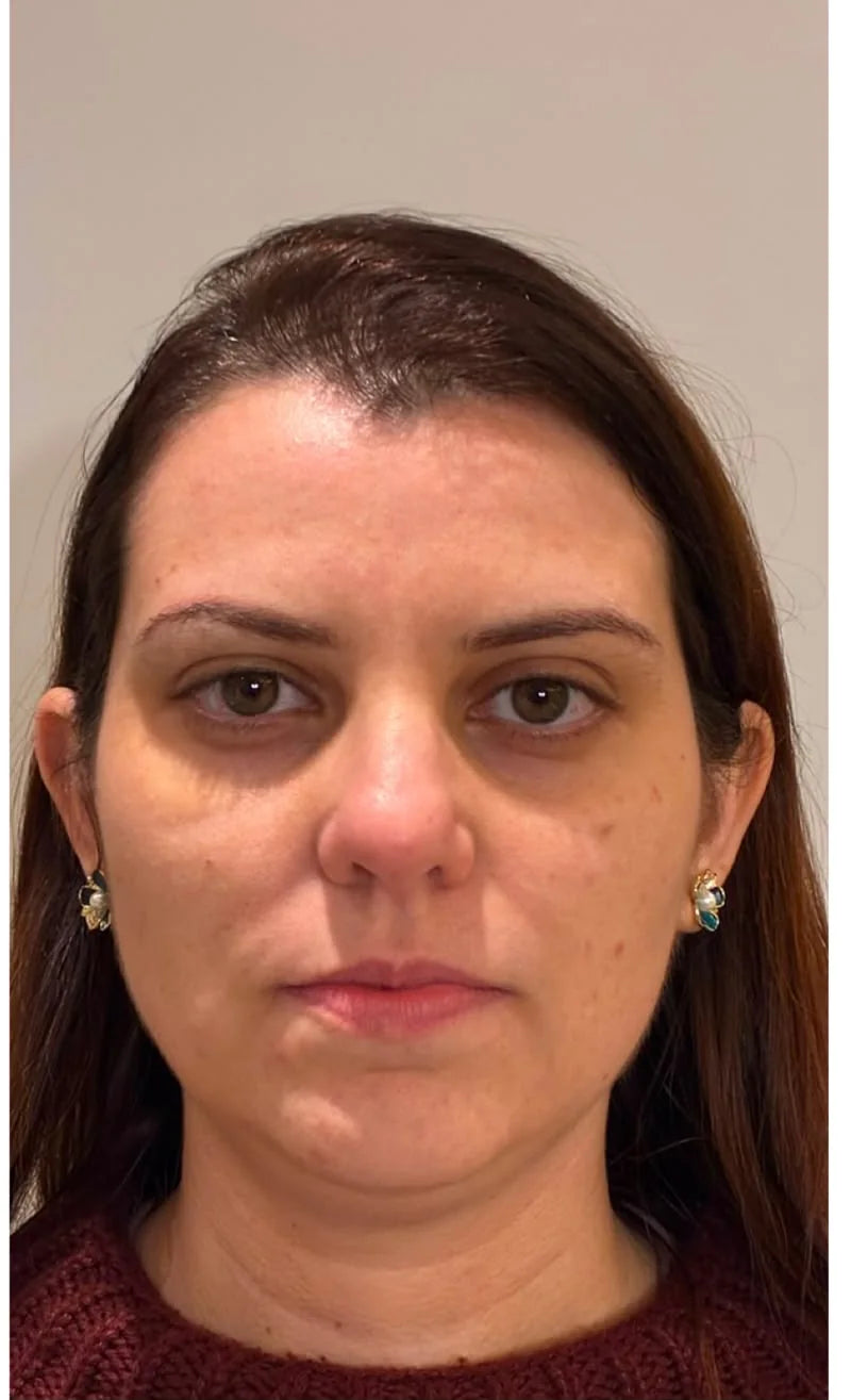The same woman's face after 90 days on the protocol