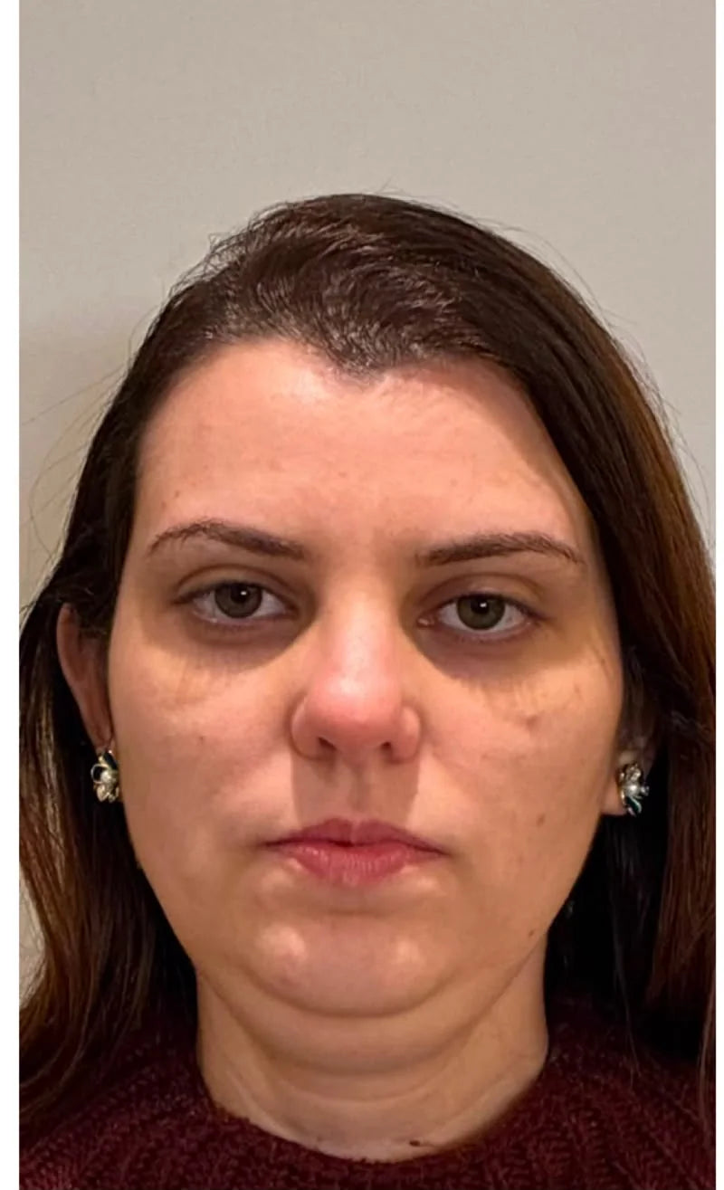 A woman's face before starting the protocol